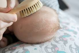 Image result for Cradle Cap