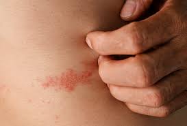 Image result for Skin Infection