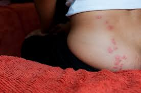 Need to hire an exterminator? What Do Bed Bug Bite Look Like Pictures Of Bed Bug Bites