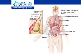 If you have been diagnosed with colon or rectal cancer, this simple guide can help you understand the kind of treatment you may need and how does the doctor know i have colorectal cancer? What Is Stage 3 Rectal Cancer Can Stage 3 Rectal Cancer Be Cured