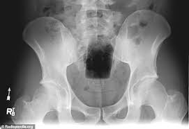 Taking a perilous journey that damn near wrecked him. Bizarre Objects Stuck Inside People S Orifices That Required Emergency Room Visits Are Revealed Daily Mail Online