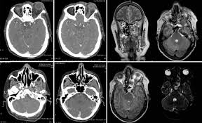 Asociación mexicana de infectología pediátrica Rhino Orbito Cerebral Mucormycosis Management Strategies To Avoid Or Limit Intracraneal Affection And Improve Survival Sciencedirect