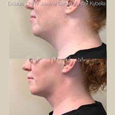 This kind of short article and images hairstyle to hide double chin and jowls published by gisselle corwin at april, 30 2019. Double Chin Houston Tx Dermatologist