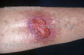 Image result for Pyoderma Gangrenosum