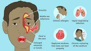 Eardrum perforation can be caused by infection, a blow to the ear, injury from an object inserted in the ear, or exposure to a sudden loud noise. Retracted Ear Drum Causes Symptoms And Treatment