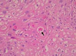 Keratin pearls can develop underneath the hood, causing more pain. Cureus A Rare Variant Of Penile Squamous Cell Carcinoma In A Man With Paraplegia
