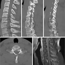Image result for Subaxial Injury Classification Scale