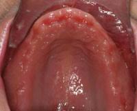 Full mouth extraction day 3. An Efficient Approach To Full Mouth Extractions Dentistry Today