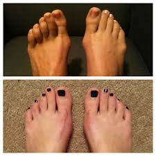 Pin On Hallux Valgus