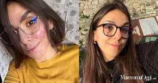 L'acne non ferma Angela: il messaggio positivo su Amazon Prime