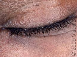 Image result for pubic lice symptoms