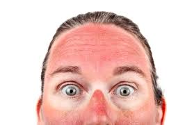 Image result for Sun Exposure
