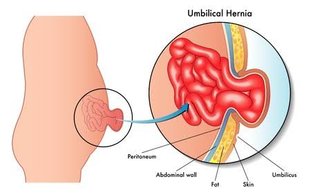 Image result for umbilical hernia"