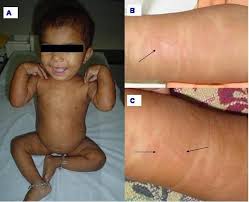 Image result for Urticaria pigmentosa children