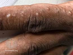 Image result for dyshidrosis