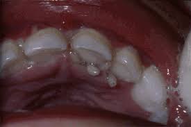 Exterior nares) allow air to enter the nose and pass into the nasal cavity. Symptoms