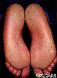 Image result for Pitting nails feet