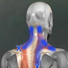 They are associated with palpable nodules in taut bands of muscle fibers. Trigger Point Injections Pickerington Oh Chiropractor Breakthrough Medical Plus