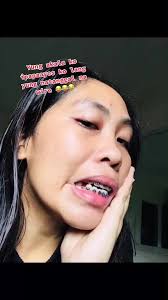 Natanggal na Wire sa Braces: Isang Nakakatuwang Karanasan