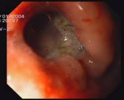 Tearing of the gastrointestinal tract.a tear in your esophagus or another part of your upper digestive tract may require hospitalization, and sometimes surgery to repair it. Upper Gi Endoscopy Frequently Asked Questions