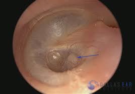 I will see the doctor in 2. Eardrum Retraction Myringoplasty Dallas Frisco Texas Ear Institute
