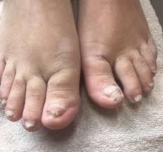 Simple enough for daily wear, but the rhinestone accented big toe makes them blingy enough for. Before And After Acrylic Toes 20 Coco Tanning Hair And Beauty Facebook