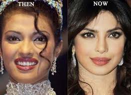 Priyanka Chopra Plastic Surgery Before And After Celebrity Surgery Plastic Surgery Photos Celebrity Plastic Surgery