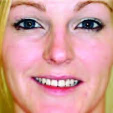 PDF) Complete denture services: clinical technique, lab costs, manpower,  and reimbursement. One-year review