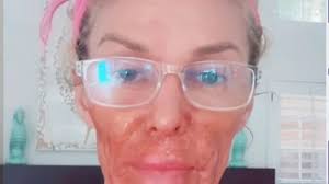 The latest brandi glanville's nair mishap burns news, videos & comments