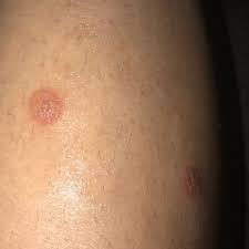 Kann Mir Jemand Sagen Was Das Ist Hautpilz Gesundheit Und Medizin Ausschlag Jucken