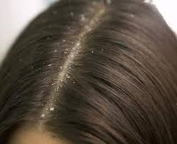 'a split end is a sign that your hair strand is damaged and can be caused by chemical, thermal or and how can i prevent split ends? Here S How These Garlic Hair Packs Can Help You With Dandruff Split Ends