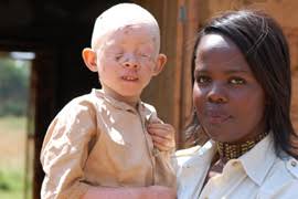 Al Jazeera&#39;s correspondent with another young albino in hiding [Yvonne Ndege] - 200972374330302621_3