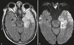 Rasmussen's encephalitis is a progressive hemispheric atrophy of unknown origin. Differential Diagnosis Of Temporal Lobe Lesions With Hyperintense Signal On T2 Weighted And Flair Sequences Pictorial Essay
