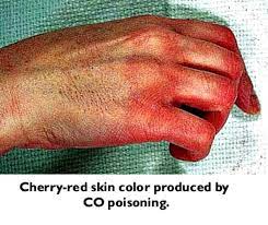Another Sign Of Carbon Monoxide Poisoning Carbon Monoxide Poisoning Carbon Monoxide Awareness