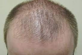 Additionally, the dermatologist will carry out simple tests to determine how healthy your hair is including the following: What Determines Dht Sensitivity And Hair Loss