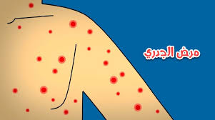 مرض الجدري والفرق بين جدري الماء والجدري الكاذب وطرق علاجه مجلتك