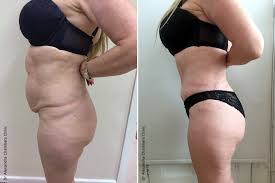 We did not find results for: Abdominoplasty Tummy Tuck London Uk