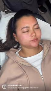Collagen Induction facial 👇🏽...