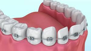 And while annual coverage caps remain about the same from year to year, the cost of dental services continues to how much would they cost with insurance? How Long Do Dental Implants Last Dental Implant Procedure Dental Implants Dental