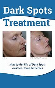 Lemon juiceworks as one of the best dark spot removers. Dark Spots Treatment How To Get Rid Of Dark Spots On Face Home Remedies Kindle Edition By Spence Tatum Health Fitness Dieting Kindle Ebooks Amazon Com