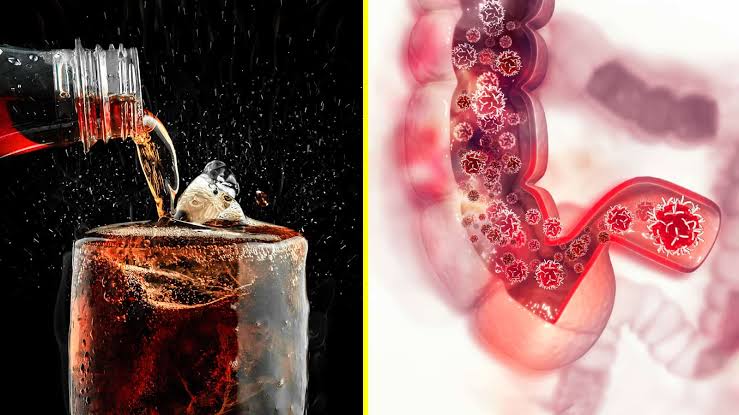 Study Reveals Soda Doubles Colorectal Cancer Risk in Women Under 50