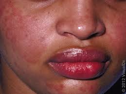 Image result for red rash face