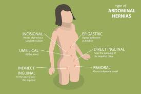 Image result for stomach hernia symptoms