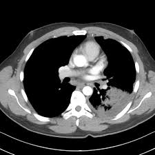 Image result for Parapneumonic Effusion