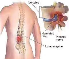 Antara ubat sakit pinggang yang mujarab adalah dengan menggunakan ramuan tradisional dari bahan semulajadi yang sememangnya telah terbukti berkesan seperti yang dikongsikan oleh laman boldsky yang menyatakan bawang putih dan kunyit juga mampu menghilangkan sakit pinggang. Rasa Sakit Pinggang Jangan Ambil Ringan Redakan Segera Dengan Ni Keluarga