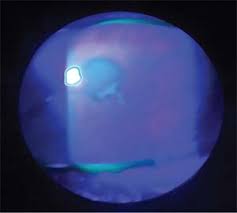 Advanced dendritic lesions during hsv epithelial keratitis can result in geographic ulcers (green arrow). How To Manage Pediatric Herpes Keratitis