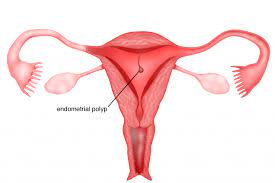 Chapter 6 Endometrial Polyps Melaka Fertility