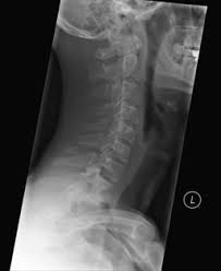 We did not find results for: Clay Shoveler Fracture Cervical Spinous Process Fractures Spine Orthobullets