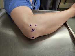 Image result for Traumatic Arthrotomy