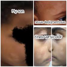 What to do about dark neck pigmentation in children?